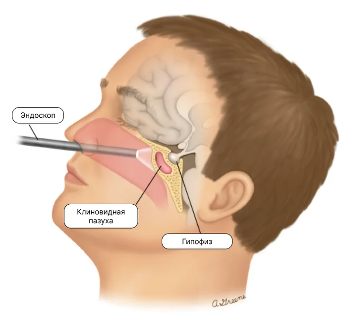 Surgery to remove a pituitary tumor - My, The medicine, Health, Cancer and oncology, Disease, Tumor, Pituitary gland, Surgery, Operation, Treatment