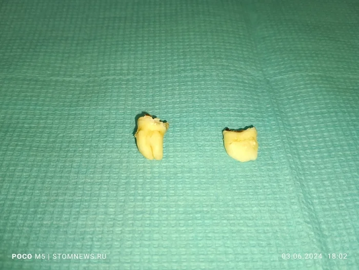 Quiz: guess what teeth these are? - My, Teeth, Dentistry, Opinion, The medicine, Doctors, Polyclinic, Wisdom tooth, Quiz, Survey, Question, Ask Peekaboo