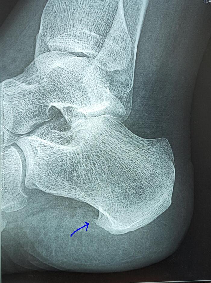 Heel spur - My, Heel spur, Spur, Heels, X-ray, Radiology, The medicine, Military enlistment office, Army