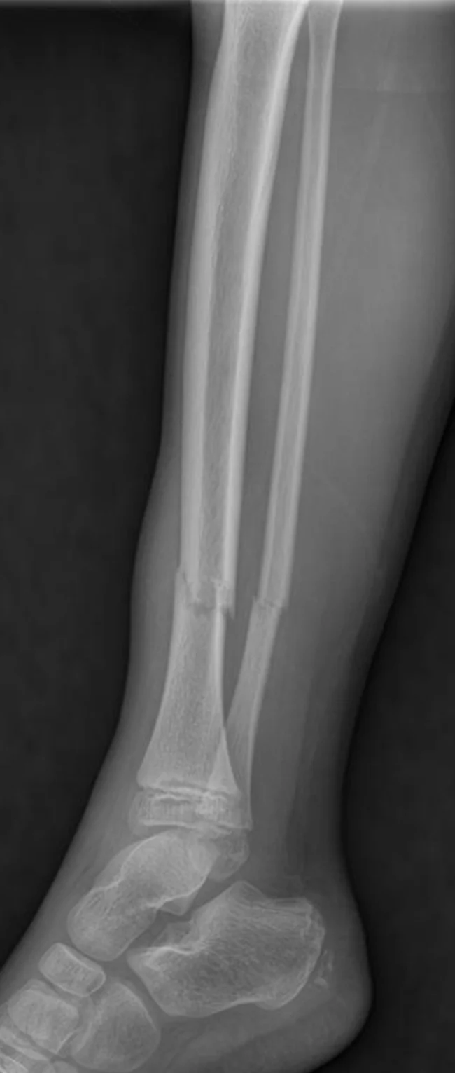 My sister fell at the skating rink, fractured her leg (fibula and tibia) - Ice rink, Fracture, Longpost