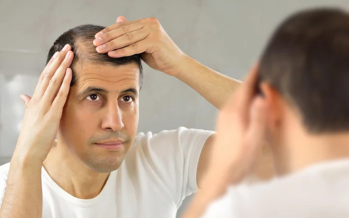Hair loss: causes and diagnosis - My, Health, Medications, Healthy lifestyle, Hair, Treatment, Nutrition