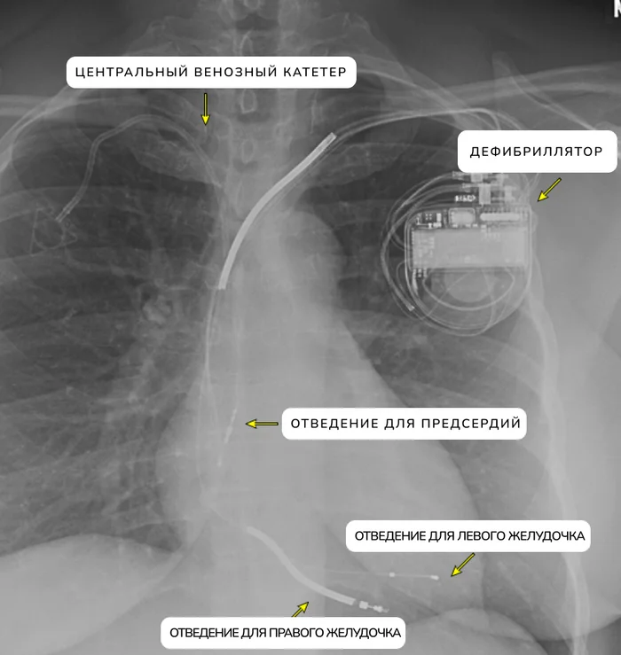 Implantable defibrillator - My, Health, The medicine, Disease, Heart, Cardiology, Treatment, Longpost