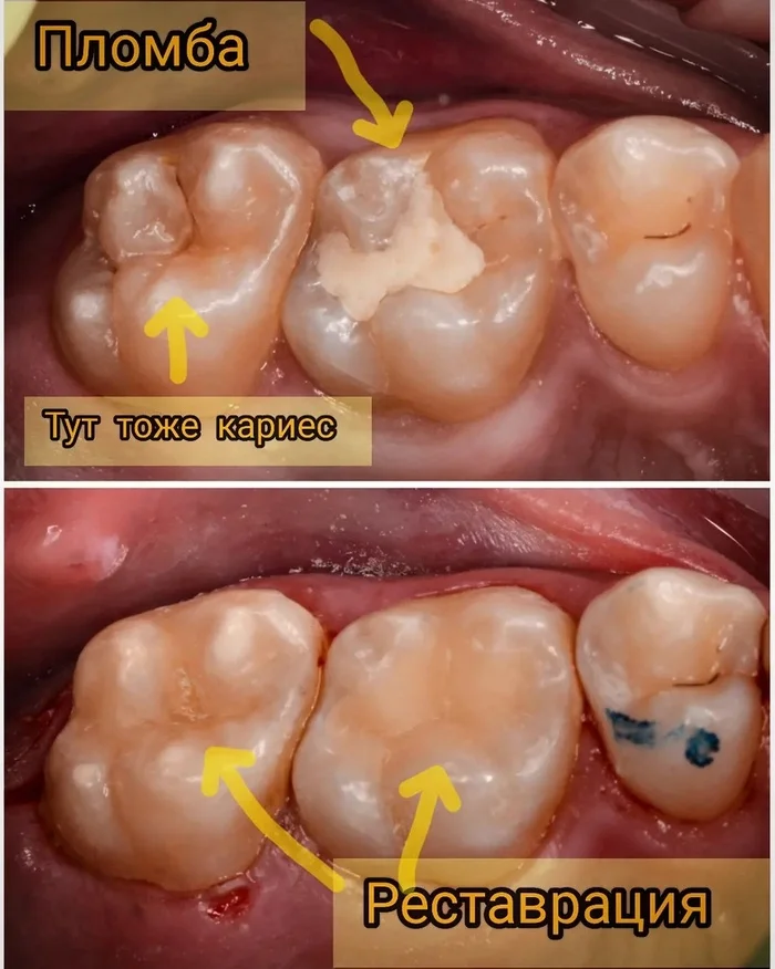 “Just putting a filling” is not easy - My, Dentistry, Teeth, The medicine, Treatment, Polyclinic, Health, Video, Youtube, Longpost