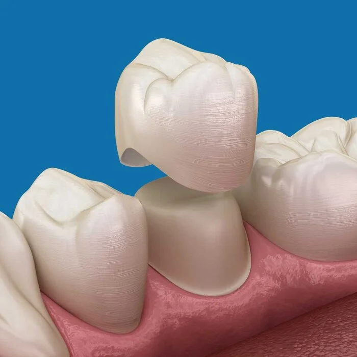 About crowns on teeth - My, Teeth, Dentistry, Health, The medicine, Treatment, Crowns, Longpost