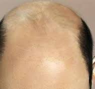 Baldness - natural, hereditary or acquired - My, Biology, Baldness, Health, Research
