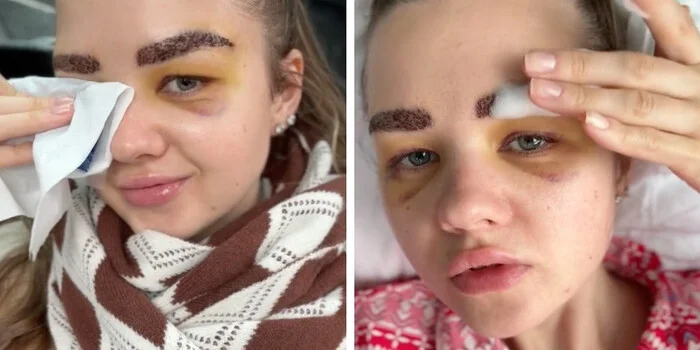 Belarusian woman underwent eyebrow transplant - Hair Transplant, Beauty requires sacrifice, Brows