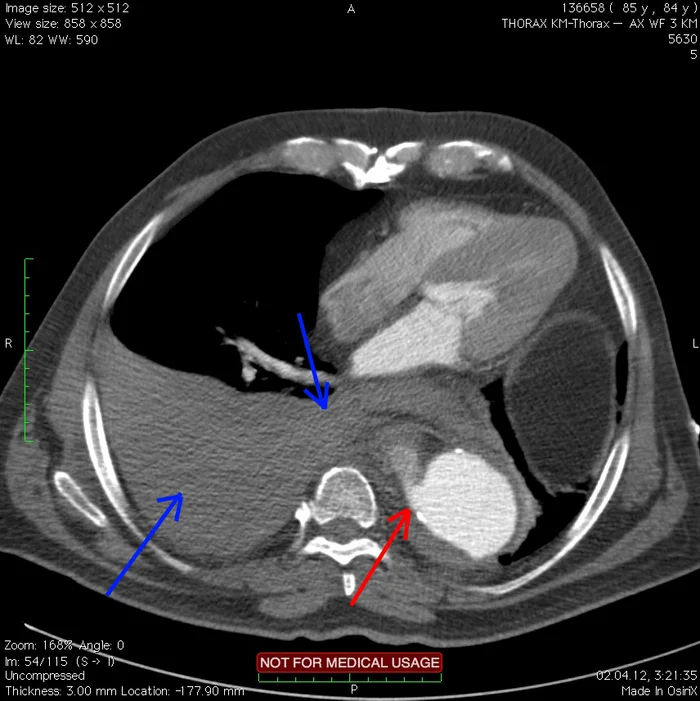 Case reports: ruptured aortic aneurysm - My, The medicine, Disease history, Observation, Disease, Aneurysm, CT, Radiology, Longpost