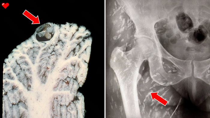 Поражение организма, после попадания в организм яиц свиного солитёра. 1 - финны в головном мозге. 2 - финны в тканях.
