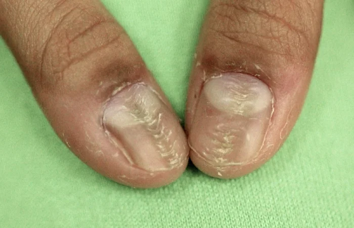 Patience and a little effort. Friction dermatoses - The medicine, Disease, Disease history, Leather, Dermatology, Corn, Friction, Pigmentation, Kvd, Longpost, My
