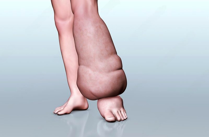 Слоновость ноги. Это заболевание вызывается паразитическими червями-нематодами, которые передаются в личиночной форме при укусе комаров.