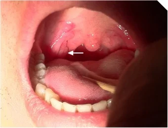 Syphilitic condyloma in a man's mouth - My, The medicine, Doctors, Dermatology, Syphilis