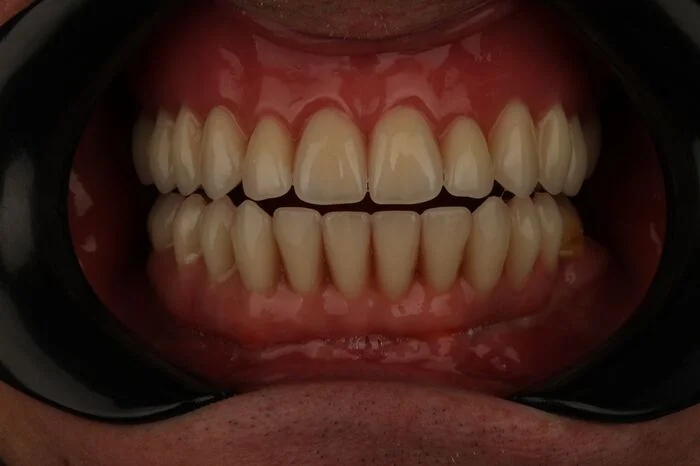 Artificial teeth. The final - My, Dentistry, Teeth, Bad teeth, Needlework with process, Video, Longpost