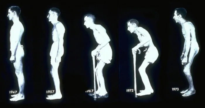 Ankylosing spondylitis - My, Health, The medicine, Disease, Bechterew's disease, Spine