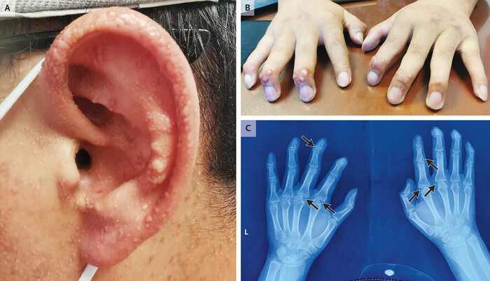 Мультицентрический ретикулогистиоцитоз