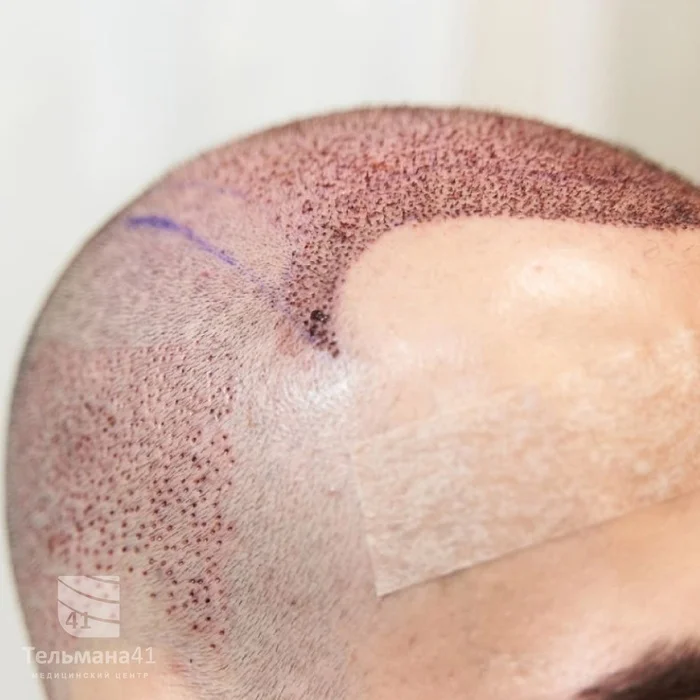 When will the marks completely disappear after hair transplantation? - My, The medicine, Operation, Treatment, Hair Transplant, Transfer, Alopecia, Bald, Bald head