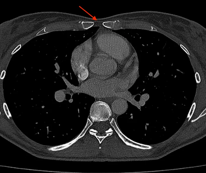 Case Studies: A Chink in the Armor - My, The medicine, Personal experience, This is the norm, Bones, CT, Radiology, Radiologist, Longpost