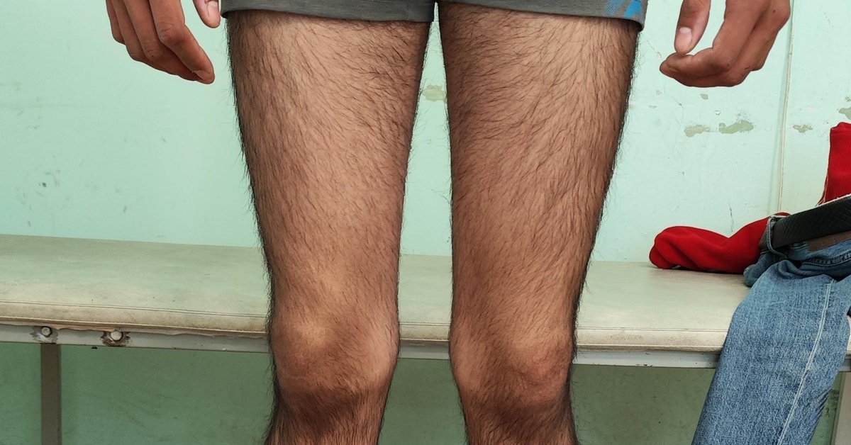 X-образная деформация нижних конечностей | Пикабу