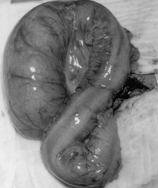 Volvulus of the sigmoid colon - My, Health, Treatment, The medicine, Gastrointestinal tract, Bowel obstruction, Disease, Operation