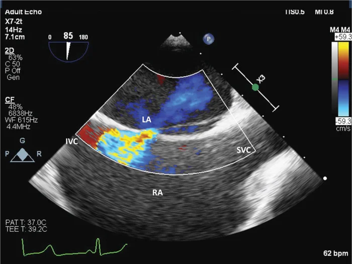 Atrial septal defect/patent foramen ovale - My, Cardiac surgery, The medicine, Informative, Pediatric Surgery, Longpost, Operation, Heart disease