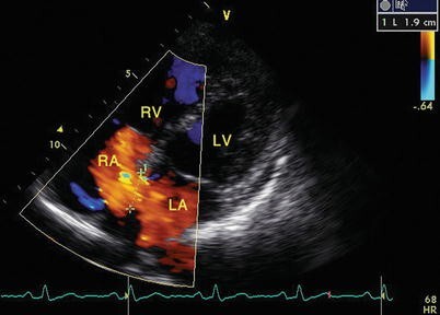 Atrial septal defect/patent foramen ovale - My, Cardiac surgery, The medicine, Informative, Pediatric Surgery, Longpost, Operation, Heart disease