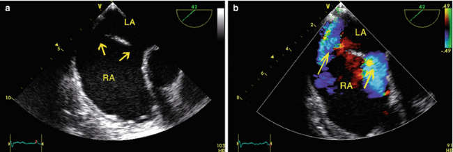 Atrial septal defect/patent foramen ovale - My, Cardiac surgery, The medicine, Informative, Pediatric Surgery, Longpost, Operation, Heart disease