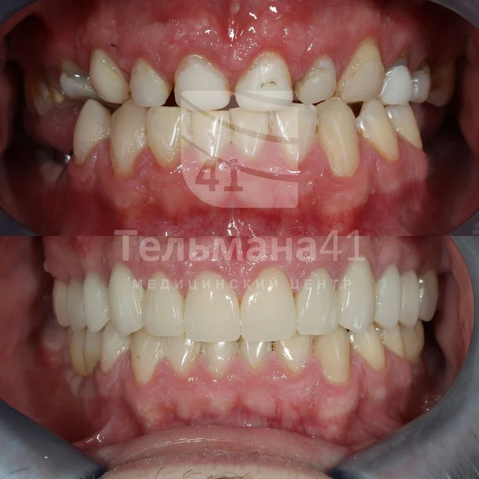 Результат ортопедического лечения - Моё, Медицина, Стоматология, Стоматолог, Виниры, Коронки
