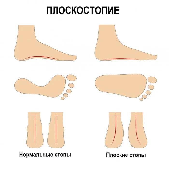 Плоскостопие - Моё, Подология, Ортопедия, Педикюр