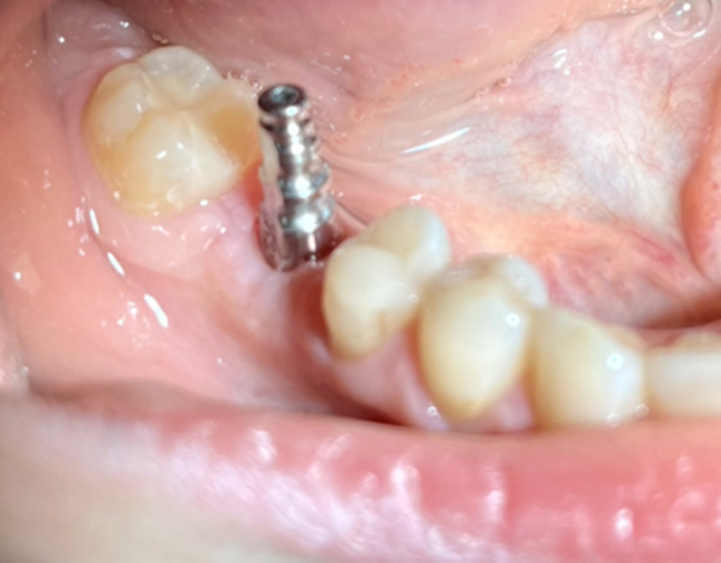 A saga about dentistry. Chapter 88. How to install a crown on a dental implant? - My, Dentistry, The medicine, Doctors, Health, Operation, Prosthesis, Crown, Teeth, Polyclinic, Implants, Dental implantation, Dentist, Ceramics, Spare parts, Question, Longpost