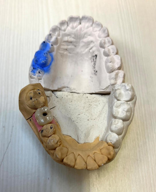 A saga about dentistry. Chapter 88. How to install a crown on a dental implant? - My, Dentistry, The medicine, Doctors, Health, Operation, Prosthesis, Crown, Teeth, Polyclinic, Implants, Dental implantation, Dentist, Ceramics, Spare parts, Question, Longpost