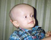 I am a boy who survived hydrocephalus in its final stages - My, Hydrocephalus, Disabled person, Longpost