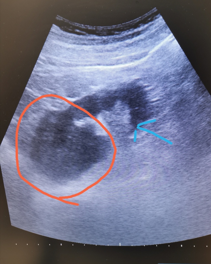 Синяя стрелка указывает на почку, а красным обвел опухоль