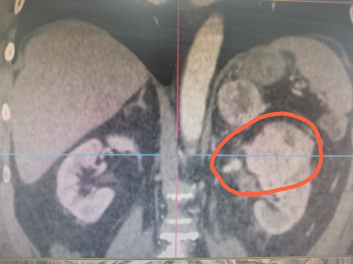 Так же красным отмечена опухоль
