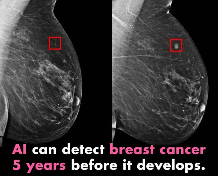 Breast Cancer Detection Using AI - My, IT, Business, Research, Innovations, Development, Telegram (link), Artificial Intelligence, Cancer and oncology