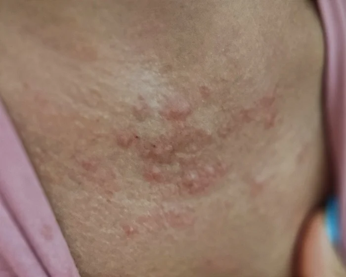 Skin rash after swimming in the sea - My, Rash, Allergy, Sea, Black Sea, Doctors need help, Help