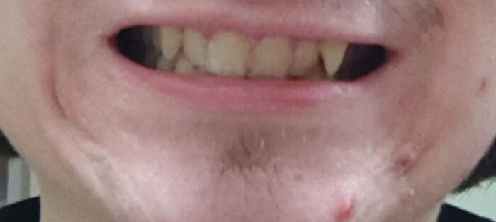 A very deep bite, can it be corrected without jaw surgery and tooth extraction? - My, Longpost, Health, Teeth, Distal bite, Malocclusion, Bite, Bad teeth