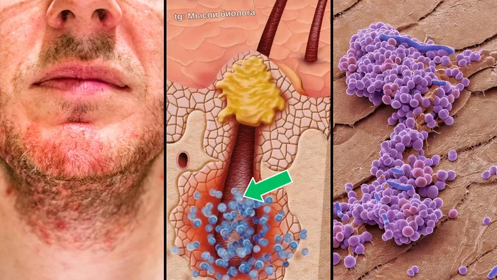 Bacterial folliculitis under a microscope - My, Biology, Nauchpop, Research, The science, Video VK, Health, The medicine, Disease, Video, Longpost