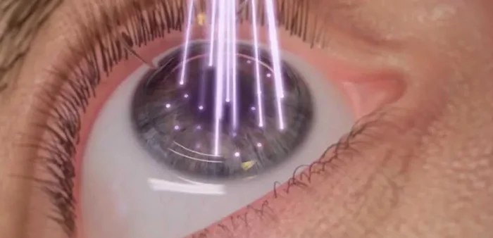 How an ophthalmologist got rid of glasses - My, LASIK, Laser correction, Ophthalmologist, Ophthalmology, Personal experience, Operation, Eye surgery, Experience, Health, First post, Eyes, Longpost