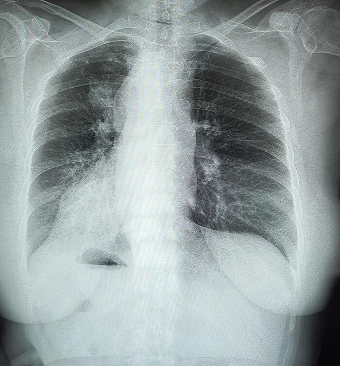 Lung cancer with metastases to the spine - My, The medicine, Army, Cancer and oncology, Metastases, Military enlistment office, X-ray, Radiology, Longpost