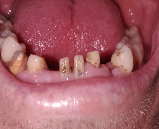 Need dental advice - My, Need advice, Dentistry, Dentist, Treatment, Teeth, Question, Ask Peekaboo, Longpost