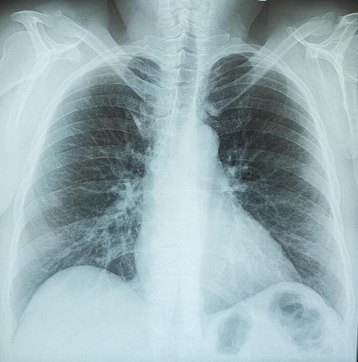 Lobe of the azygos vein (Reisberg's lobe) - My, The medicine, Military enlistment office, Lungs, X-ray, Radiology, Army, Longpost