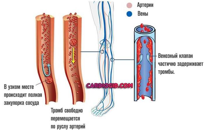 Blood clots what it looks like - Thrombus, The medicine, Health, Longpost