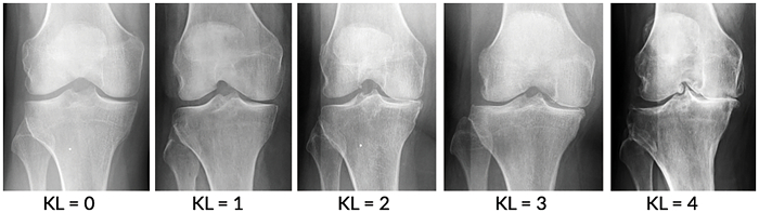 Radiological classifications of osteoarthritis - My, The medicine, Army, X-ray, Radiology, Gonarthrosis, Joints, Military enlistment office, The appeal, Longpost