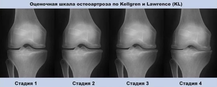 Radiological classifications of osteoarthritis - My, The medicine, Army, X-ray, Radiology, Gonarthrosis, Joints, Military enlistment office, The appeal, Longpost