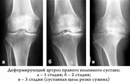 Radiological classifications of osteoarthritis - My, The medicine, Army, X-ray, Radiology, Gonarthrosis, Joints, Military enlistment office, The appeal, Longpost