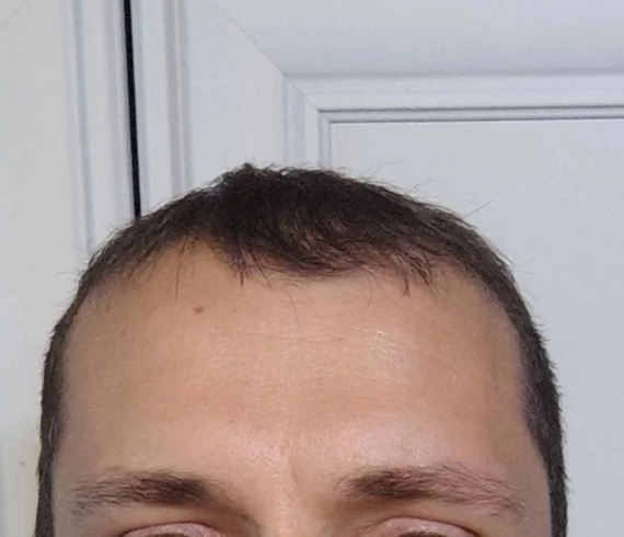 One year after hair transplant - My, Hair Transplant, Alopecia, Longpost