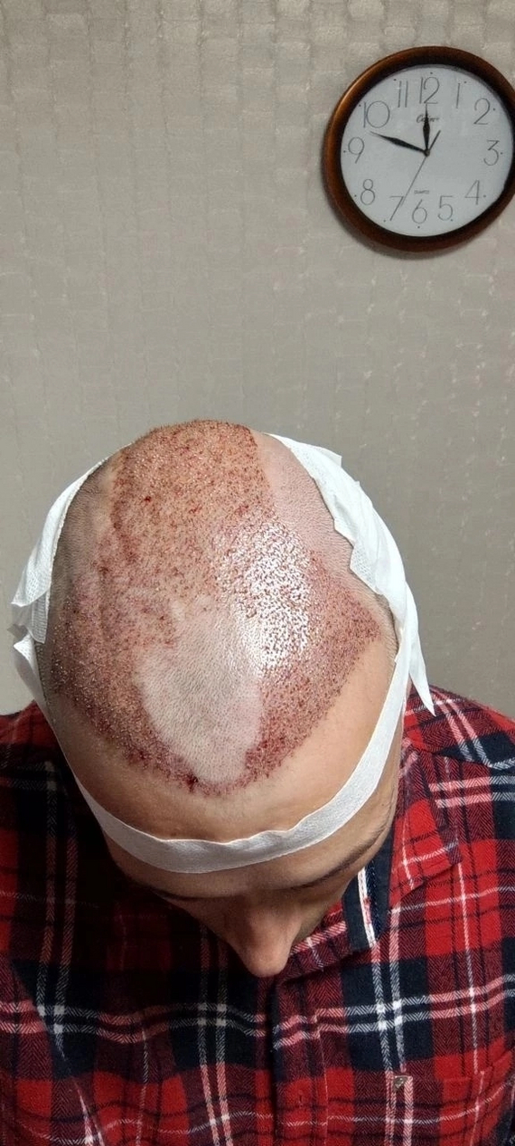 One year after hair transplant - My, Hair Transplant, Alopecia, Longpost