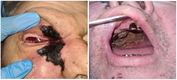 *Мукормикоз - опасная и реальная грибковая суперинфекция в период пандемии COVID-19 / С. А. Бурова, А. В. Таганов, А. А. Каштанова, Ю. В. Горбачева // Успехи медицинской микологии. – 2022. – Т. 23. – С. 51-54. – EDN MBHFNZ.