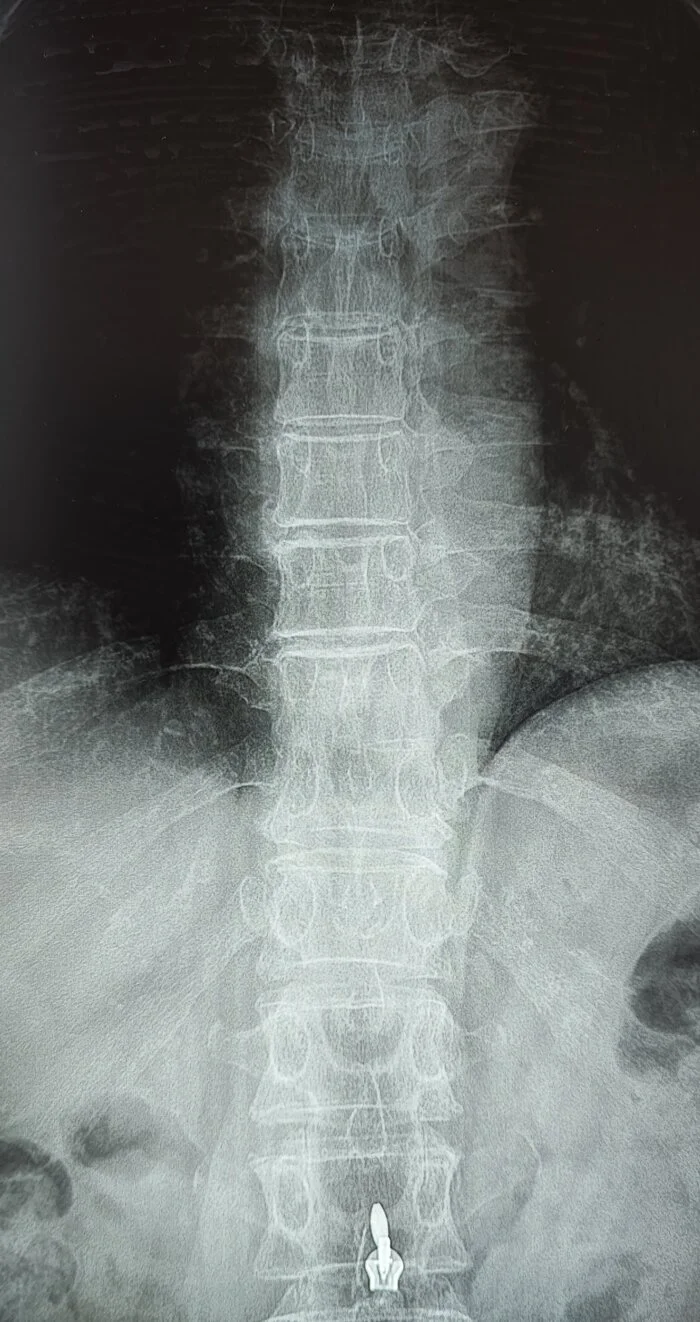 Анкилоз позвонков ГОП - Моё, Медицина, Армия, Позвоночник, Рентген, Рентгенология, Военкомат, Длиннопост
