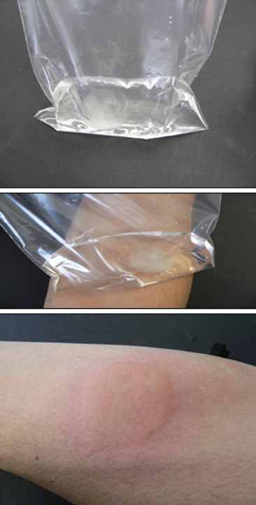 Ice cube test for cold urticaria - My, Health, The medicine, Disease, Hives, Cold, Bathing