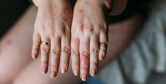 <!--noindex--><a href="https://pikabu.ru/story/prostoy_mazok_s_kozhi__klyuch_k_tochnyim_lekarstvam_ot_autoimmunnyikh_zabolevaniy_11725966?u=http%3A%2F%2FDermab.io&t=Dermab.io&h=08107f9b031a74c9418c28f16816f68bf2be601e" title="http://Dermab.io" target="_blank" rel="nofollow noopener">Dermab.io</a><!--/noindex--> фокусируется на биомаркерах как на индикаторе реакции пациента на биологическое лечение псориаза (Depositphotos)